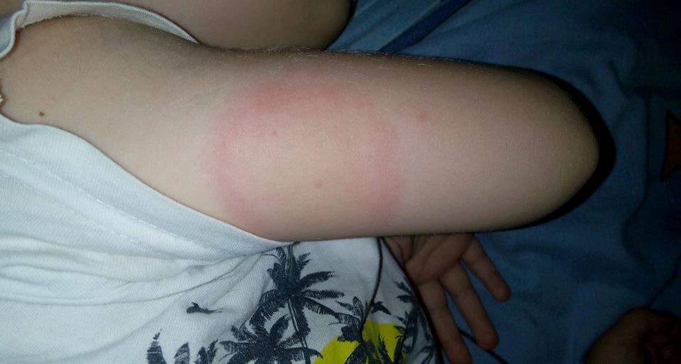 В Харькове ребенок оказался в подвешенном состоянии после укуса насекомого