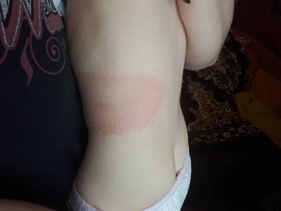 Полуторагодовалая девочка подцепила страшную болезнь в городе под Харьковом