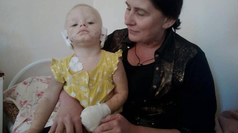 В Харькове спасают ребенка, которому собака отгрызла уши (фото)