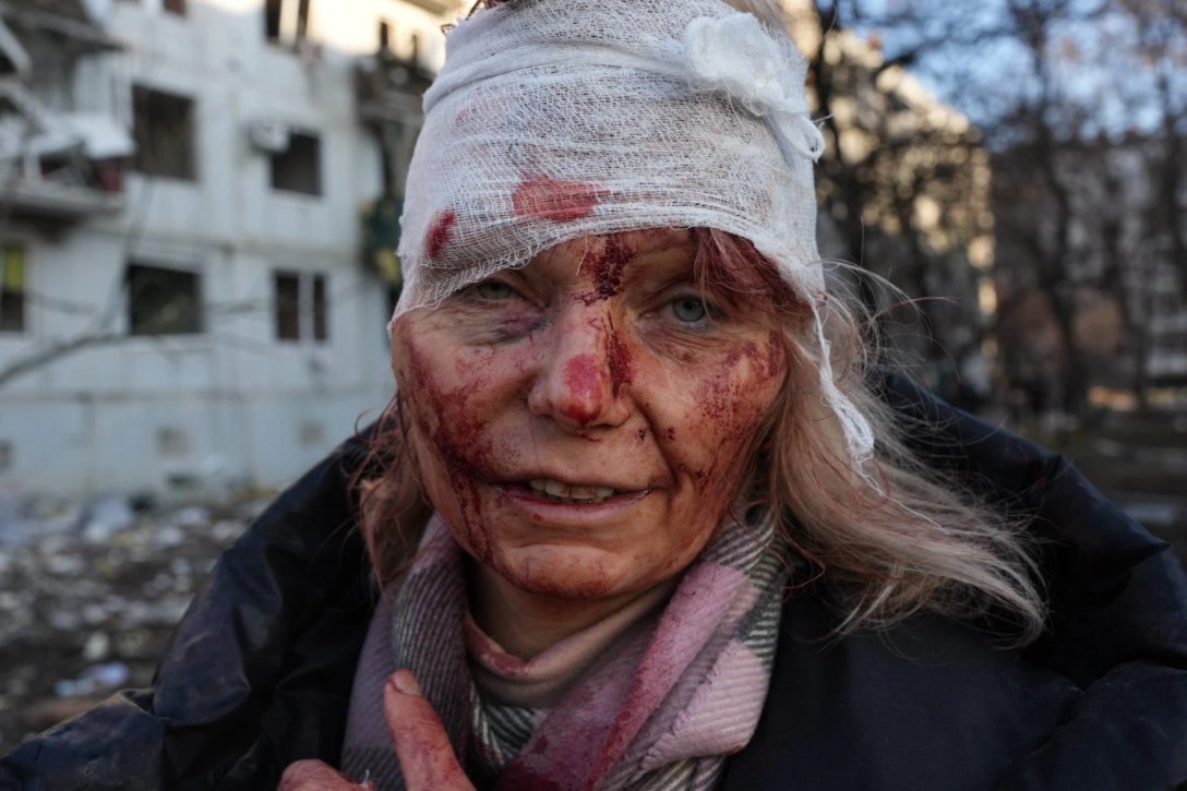 Фотографія з пораненою вихователькою з Харківщини перемогла на міжнародному конкурсі